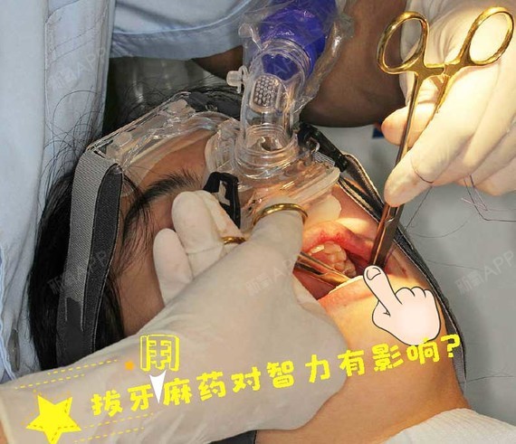 拔牙打麻药对大脑有影响?拔牙后需注意?很多