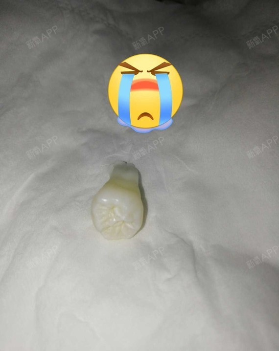 拔牙打麻药对大脑有影响?拔牙后需注意?很多