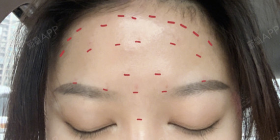 73除皱针的禁区这几个位置千万不能打63