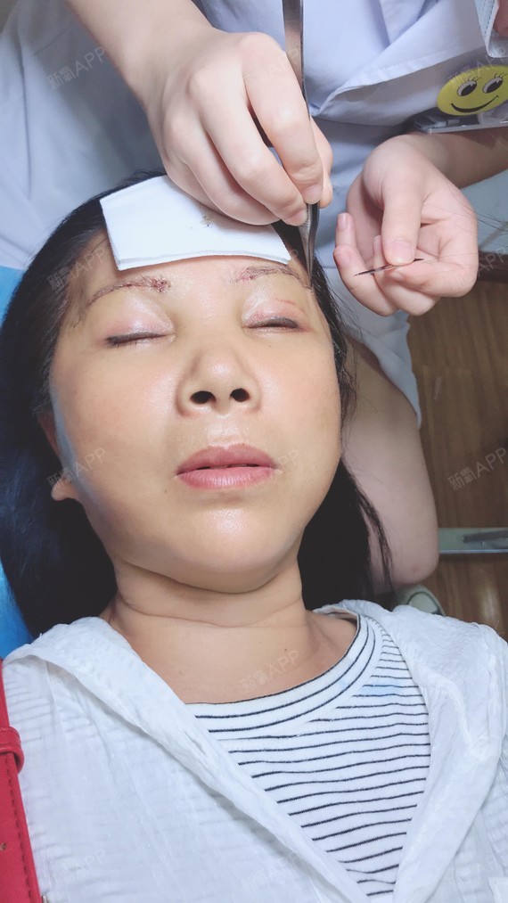 做完线雕 脂肪填充脸 提眉 除皱一周了,面部整体的_圈子-新氧美容整形