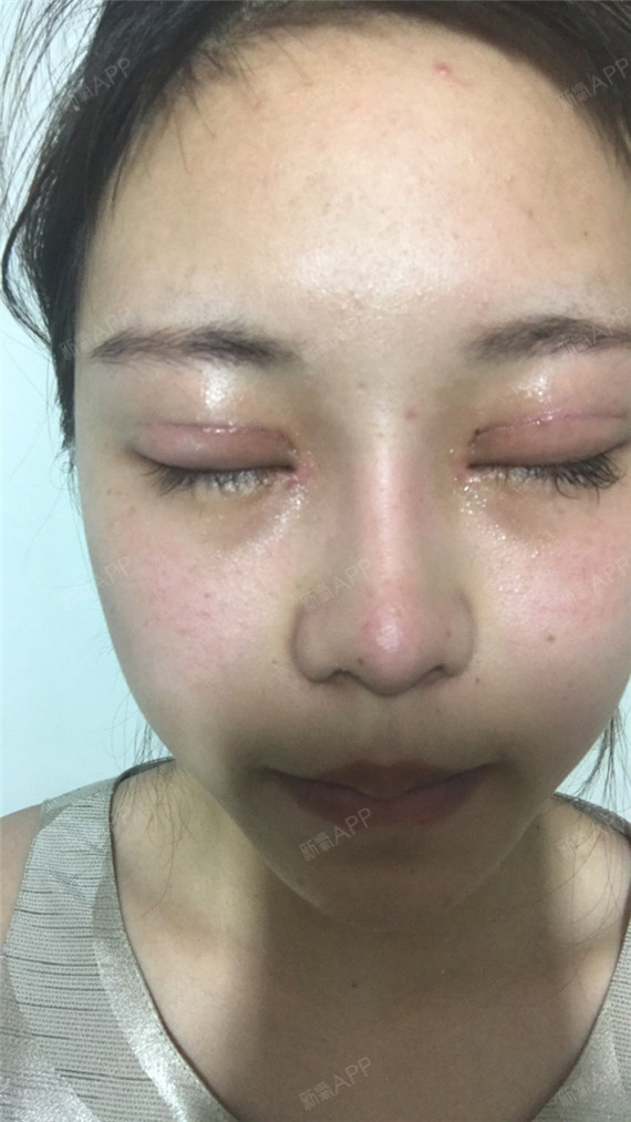 今天来拆线啦,拆完线才觉得自己是真正做了双眼皮,之_圈子-新氧美容