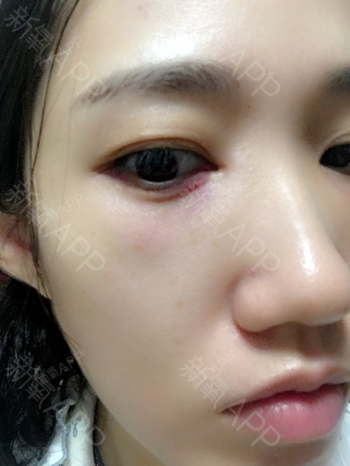 内切祛眼袋的第一天,有点红肿淤青,不过眼袋已经祛除_圈子-新氧美容