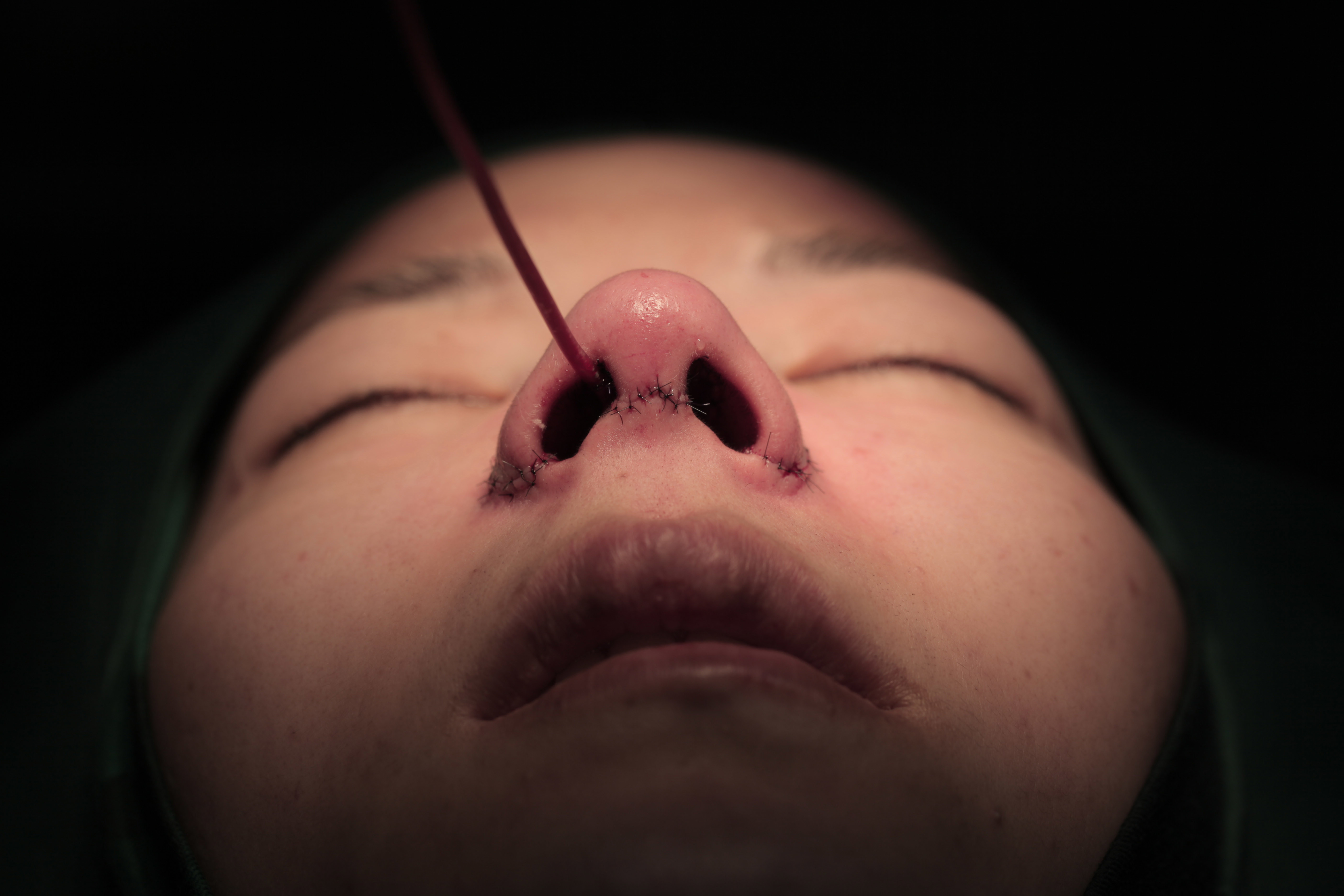 填充鼻基底的手术入路有两种,分别是口内入路和鼻整形切口入路.