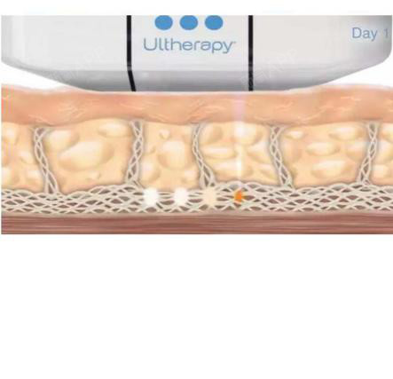 关于点阵激光一次有效果吗?多久恢复?不来瞧