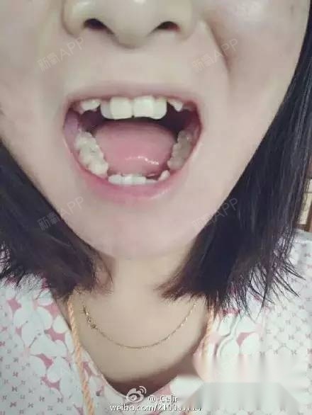 虎牙正畸4个月变化很大,进口自锁效果很好痛苦少!