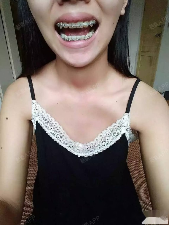 骨性龅牙的看过来,只戴牙套3个月前后的效果惊人励志_圈子-新氧美容