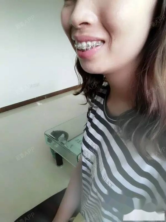 牙套三个月 龅牙还一点都没收,那个医生居然说已经差不多了