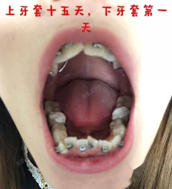 回到家牙齿也没感觉,更是开心到飞起,到了晚上牙齿得隐隐作痛像无声的