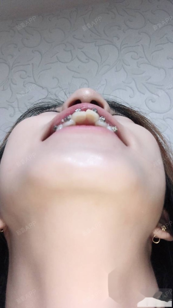 回到家牙齿也没感觉,更是开心到飞起,到了晚上牙齿得隐隐作痛像无声的