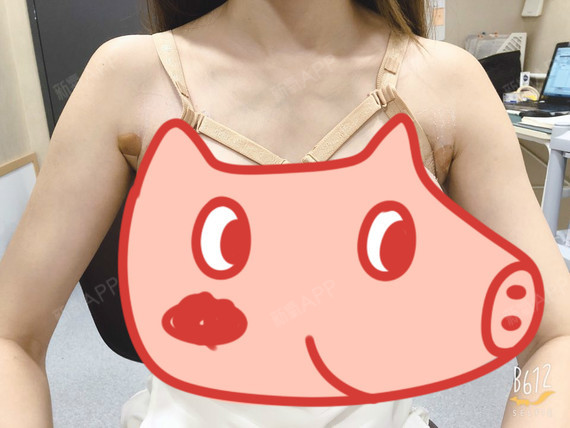 假体隆胸好不好_效果图_amy酱假体隆胸术后第5天_新氧美容整形