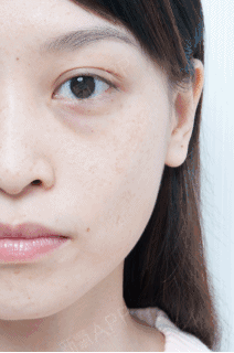 祛眼袋前,你应该知道卧蚕/泪沟与眼袋的区别!