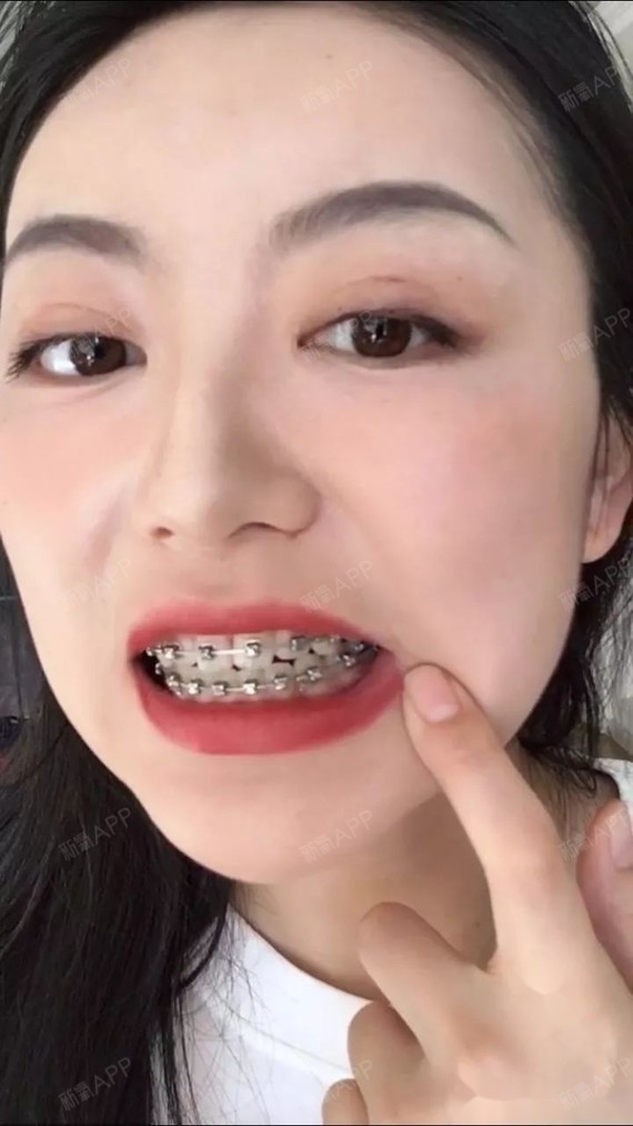 一年半牙齿矫正,凸嘴得到改善,下巴呼之欲出呀