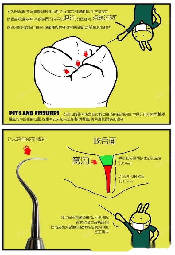 窝沟封闭漫画版