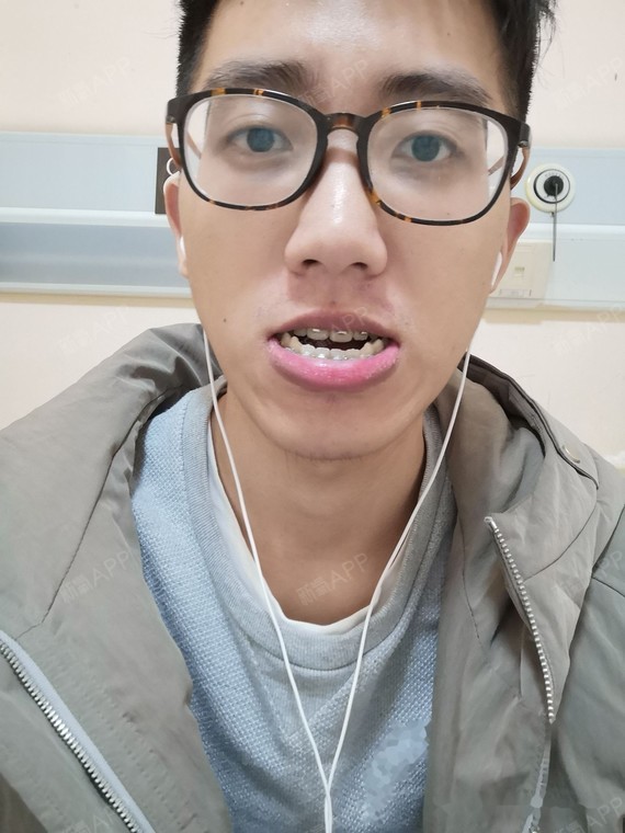 从初中发现自己地包天,成了自卑的心结,就多方面了解了正颌手术的全