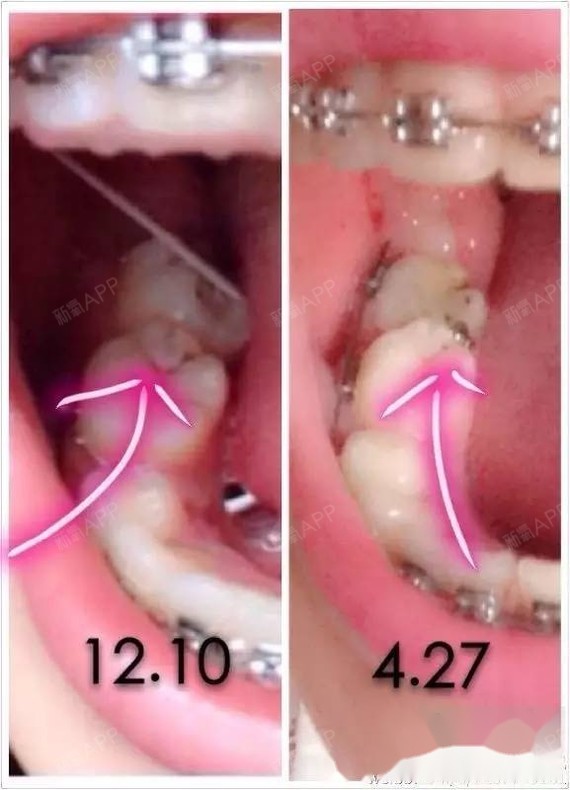 我的问题有深覆颌深覆盖锁颌骨性和牙性龅牙治疗:单纯_圈子-新氧美容
