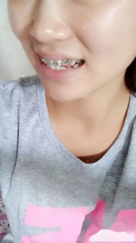 我的钢牙日记我的牙齿并不严重,只是虎牙突了一点,都_圈子-新氧美容