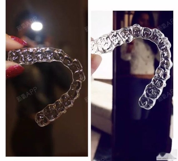 国产正雅隐形牙套, 10个月完成矫正,效果非常满意