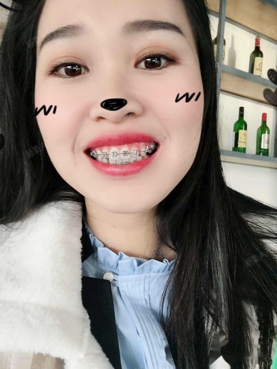 牙齿不齐侧面嘴凸戴牙套是我做过最不后悔的事