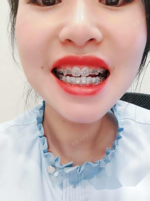 牙齿不齐侧面嘴凸戴牙套是我做过最不后悔的事