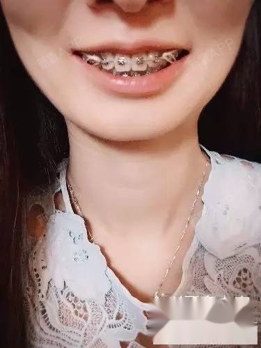 骨性加牙性,深覆合深覆盖,牙套两年8个月,就想臭美_圈子-新氧美容整形