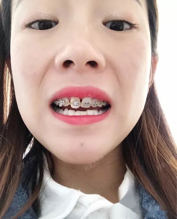 只戴了上牙套矫正多生牙,我妈都说正畸后换了一个人一样