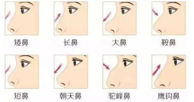 我的鼻子有点塌 隆完鼻后颜值会提升吗 新氧美容整形