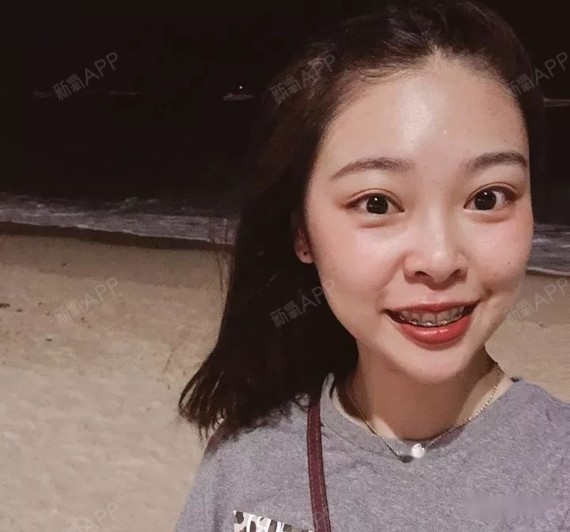 牙齿内收人看起来也年轻了很多