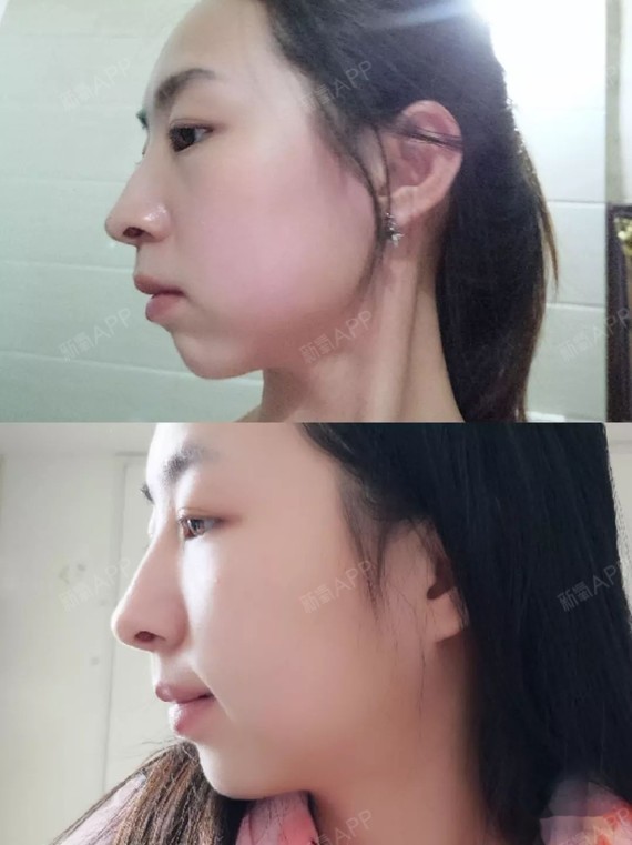 戴牙套207天侧脸对比 戴牙套后的第207天侧脸变化