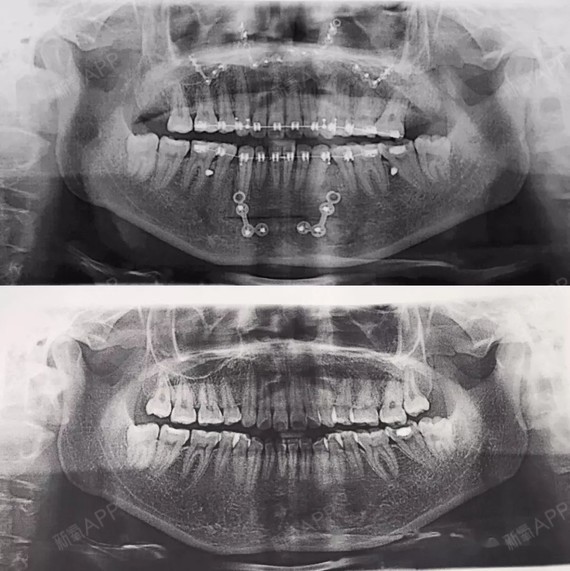 露笑龈双颌前凸下巴后缩正颌手术二次矫正