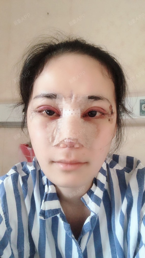 隆鼻第一天,照片看起来是不是很丑啊,哈哈没关系做鼻_圈子-新氧美容