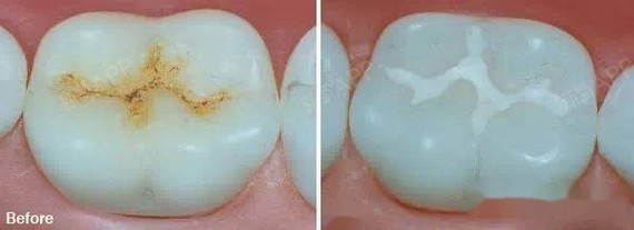 窝沟封闭的最佳年龄是几岁?