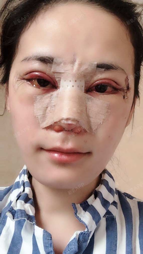 隆鼻第一天,照片看起来是不是很丑啊,哈哈没关系做鼻_圈子-新氧美容
