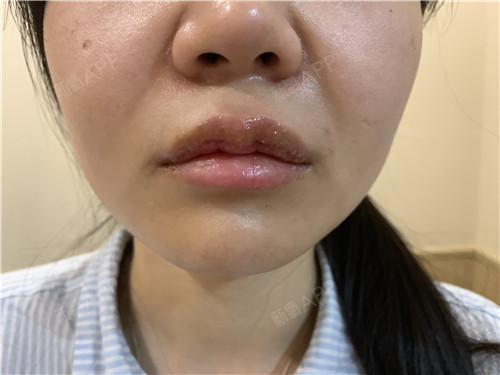 【武汉化蝶】唇珠就是上嘴唇中间那么一点点,一般小孩_圈子-新氧美容