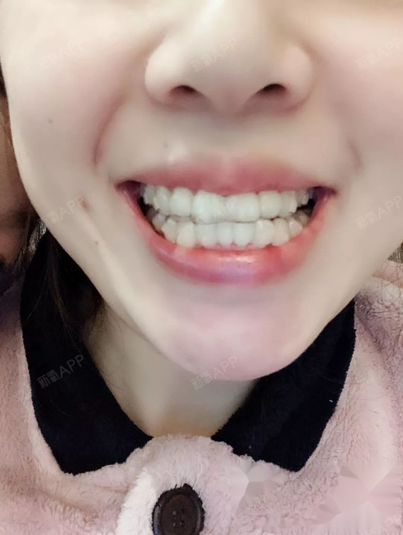 戴牙套4个多月的对比照片