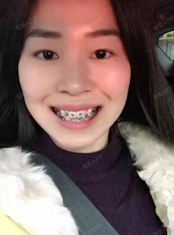 嘴凸牙齿乱32岁戴上牙套拔牙打了骨钉正畸对脸型和侧脸有改变