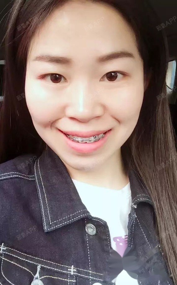 嘴凸牙齿乱32岁戴上牙套拔牙打了骨钉正畸对脸型和侧脸有改变