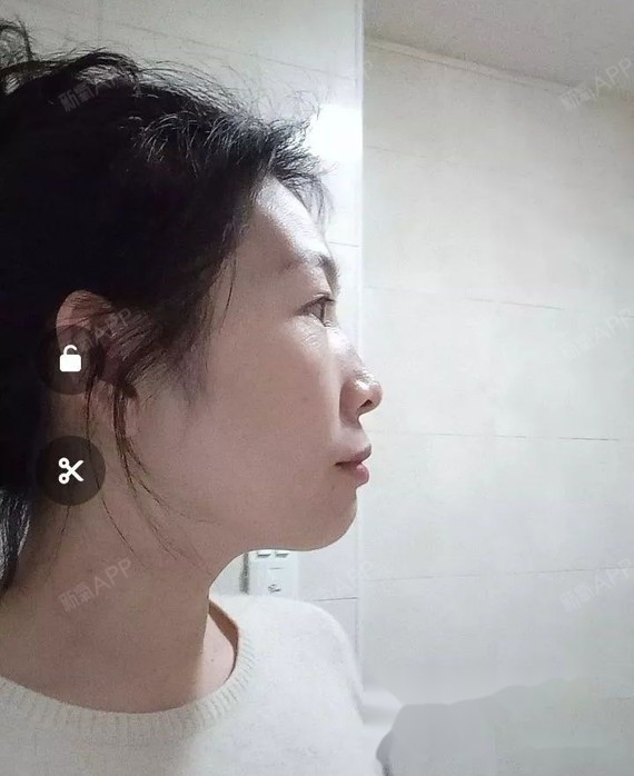 16年12月份,正畸前 ▲ 正畸半年17年5月左右开始出现牙套脸