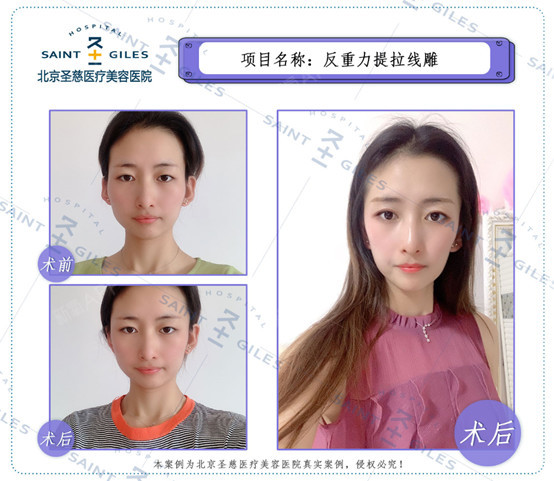 【想做面部埋线提升,价格几千几万的都有,怎么