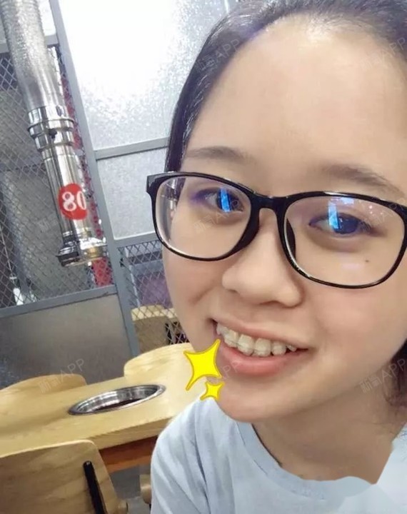 虎牙,门牙像防盗门,拔了4颗牙.摘牙套啦,事实证明_圈子-新氧美容整形