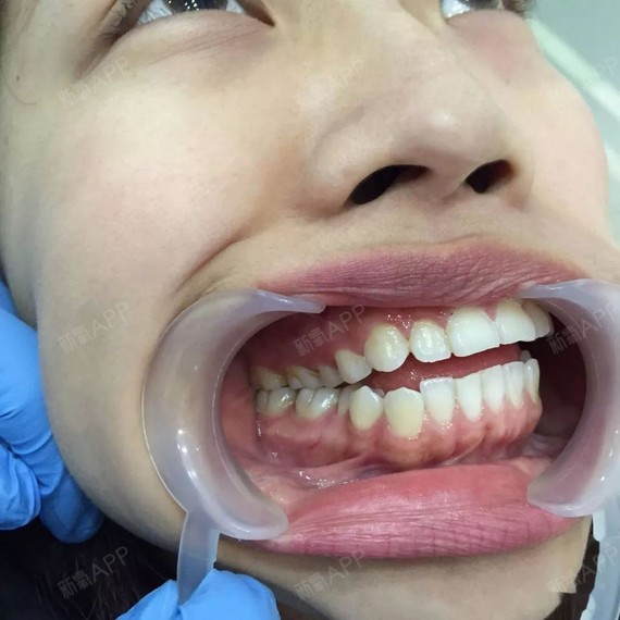 前牙开颌,中度深覆盖,正雅隐形牙套2年3个月,现在_圈子-新氧美容整形