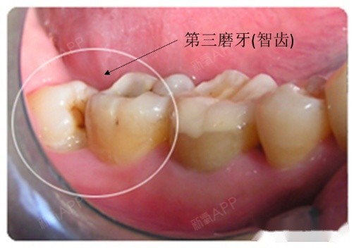 原来,智齿,学名叫第三磨牙,通常在人17岁至25岁时出现在口腔中.
