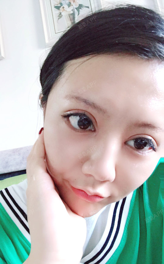 我做的开眼角,内外眼角