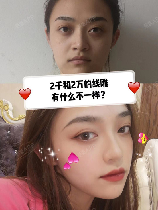 【想做面部埋线提升,价格几千几万的都有,怎么