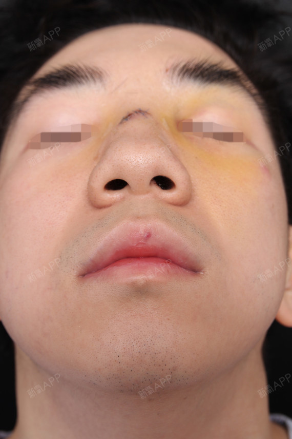 耳软骨复合隆鼻好不好_效果图_韩国清新整形外科医院耳软骨复合隆鼻术