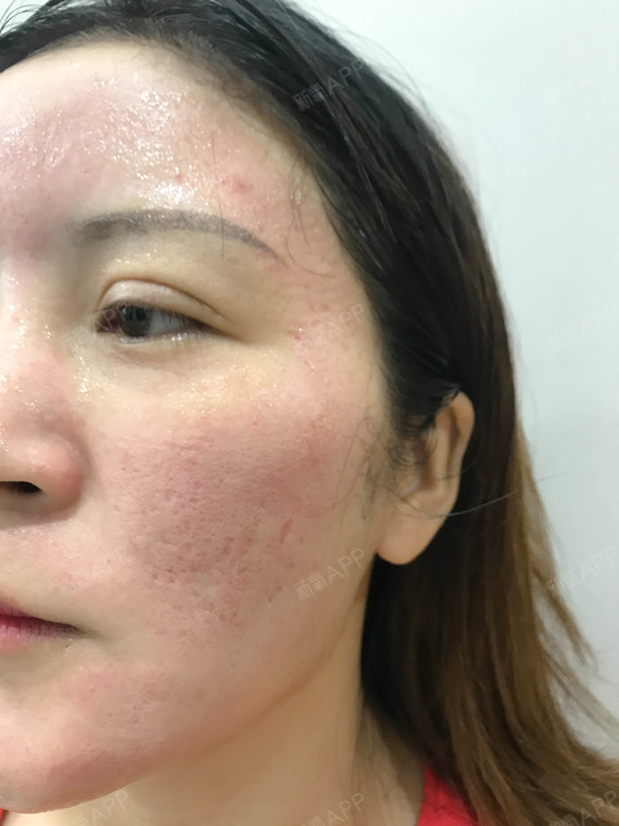 伊肤泉微针好不好_效果图_氧气2dpqz伊肤泉微针术后第0天_新氧美容