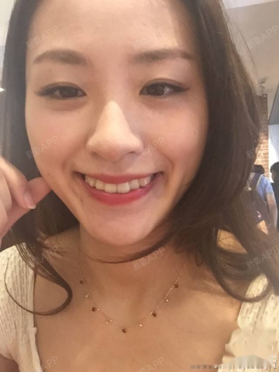2年7个月异地矫正结束,没拔牙只片切,和虎牙saybyebye啦