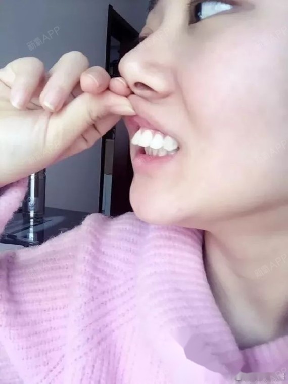 上颌骨截骨三块后移下颌骨整体前移颏成型第四军医大正颌商洪涛教授