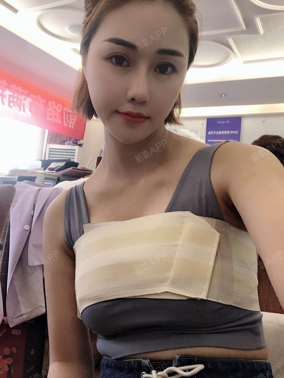 假体隆胸好不好_效果图_思考不出小迷糊假体隆胸术后第7天_新氧美容