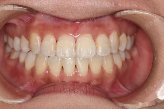 前牙对刃咬合问题非常严重完成所有牙齿矫正改变非常明显结果喜人