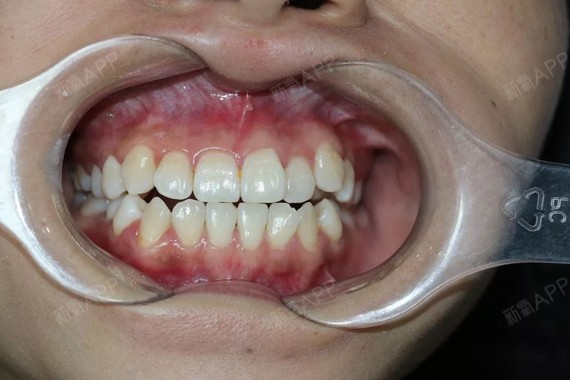 前牙对刃咬合问题非常严重完成所有牙齿矫正改变非常明显结果喜人